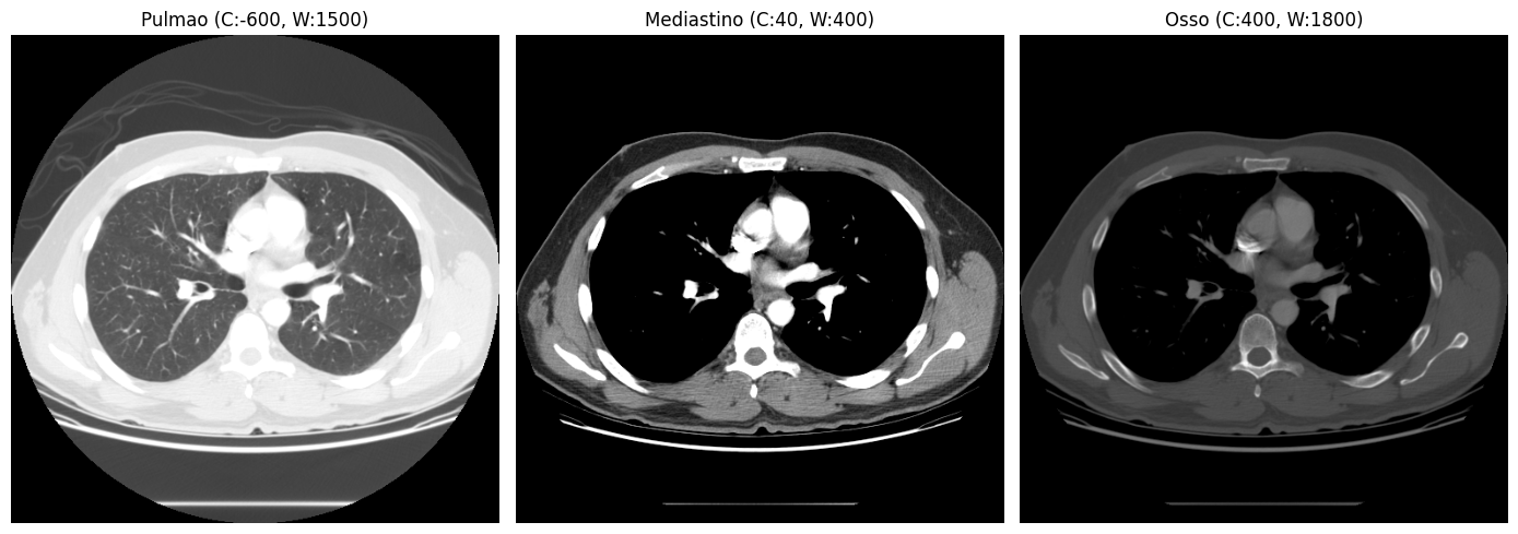 Visualização de um CT scan com diferentes janelas: pulmão, mediastino e osso